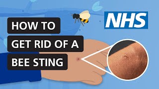 How to get rid of a bee sting | NHS