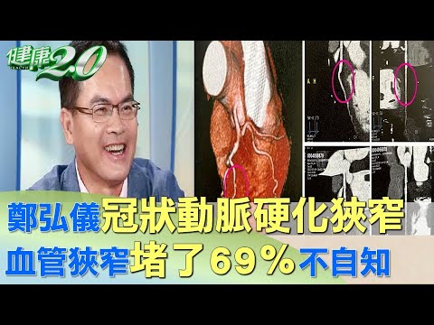 鄭弘儀冠狀動脈硬化狹窄 血管狹窄”堵了69％”不自知 健康2.0