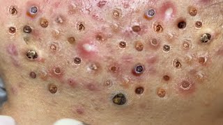 Loan Nguyen Acne Treatment 124c