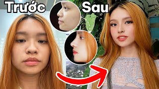Mình Đã Phẫu Thuật Thẩm Mỹ Thành Công!!!