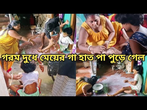 একি সর্বনাশ হলো মেয়ের গায়ে গরম দুধ পড়ে গা হাত পা পুড়ে গেল