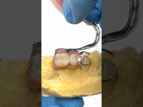 Adding a Crown for a Metal Clasped Partial #lsk121shorts #dentistry #teeth