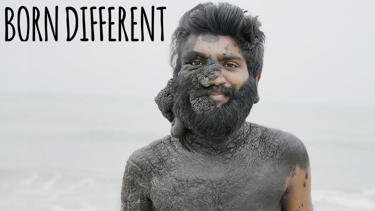 80% of my skin is covered in moles - born different