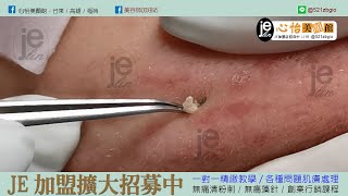 JE海內外加盟店招募中-林季儀老師親自培訓-低門檻-含金量超高的珍貴無痛清粉刺淨痘技銜-名額有限