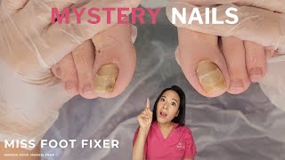 The Mystery Behind These Nails | Strange Nail Condition Uncovered!