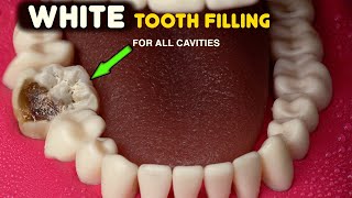 Tooth Restoration With WHITE FILLING! The Ultimate Before And After Transformation