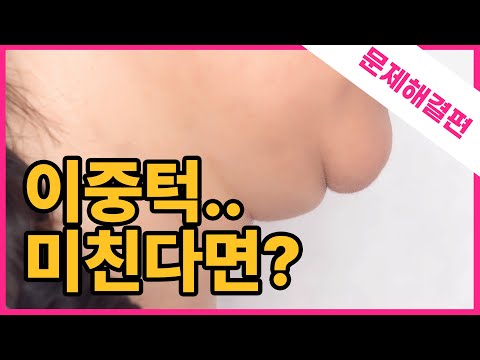 🤬턱이 두개...어떡해요?🤬/ 시술위키 울쎄라 문제해결편