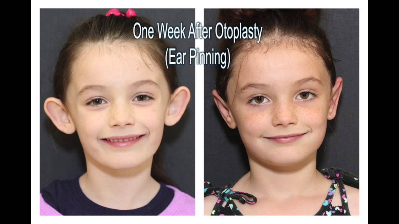 Girl's before and after ear pinning surgery.