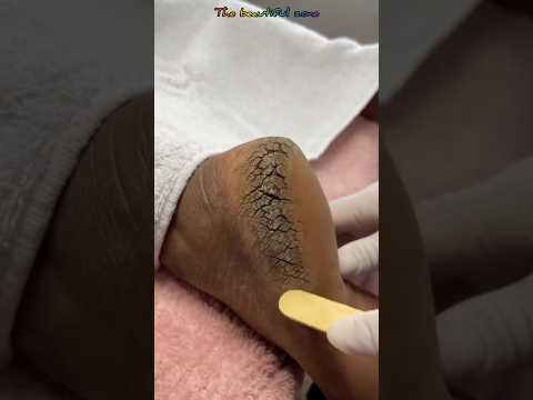 Pedicure extraction foot cleaning