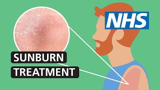 Sunburn treatment: how to get relief if you’re sunburnt | NHS
