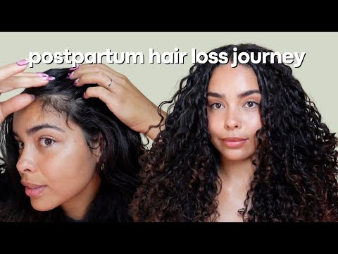 Postpartum hair loss journey + what I'm using to re-grow my hair line!