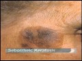 Skin Lesions and Treatments