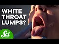 Understanding Tonsil Stones