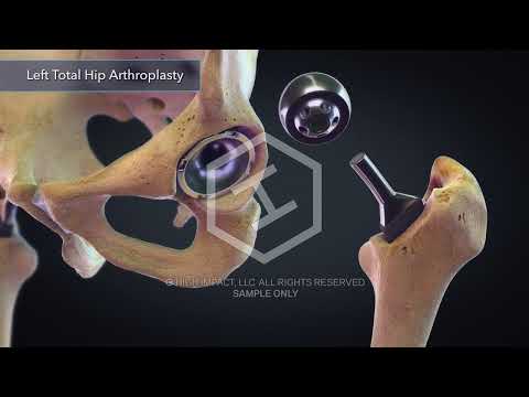 $21M Verdict: Animation Clearly Shows Defective Hip Implant