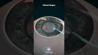 Clear Vision Again! Understanding Cataract Eye Surgery