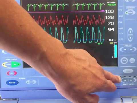 balloon pump basics for nurses balloon pump basics for nurses