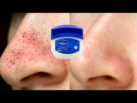 Remove blackheads with vaseline | How to use vaseline for blackheads on nose