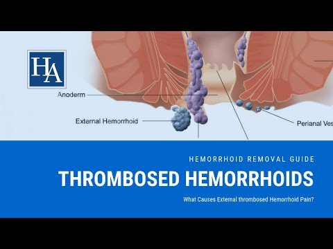 Thrombosed Hemorrhoids - What Causes External...