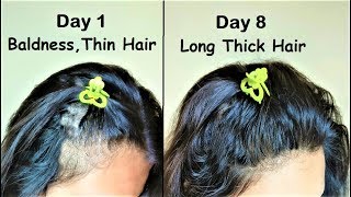She Had Very Thin Hair She Used This Got Thick Hair In 1 Week
