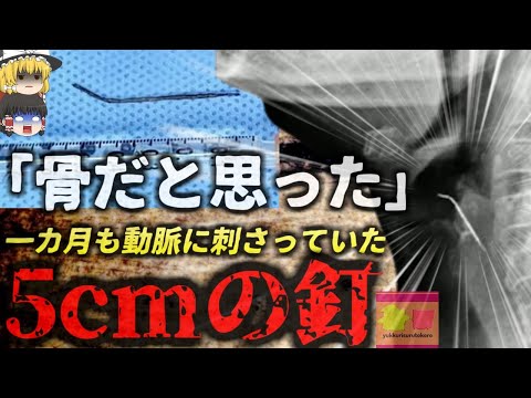 【2024年】『魚の骨だと思った』肉料理を食べ喉に違和感を覚えた女性 検査した結果喉に刺さっていたのは骨ではなく『5cmの釘』その状態で一カ月も過ごしており…【ゆっくり解説】