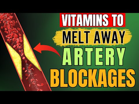 Remove Artery Plaque Naturally: 14 Powerful Vitamins and Supplements! (not what you think)