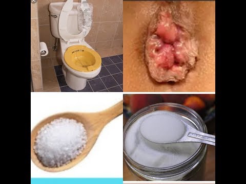 How To Treat Hemorrhoids At Home Naturally within 24...