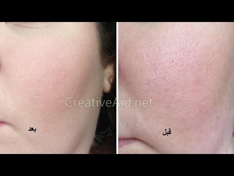علاج قوي وطبيعي للتخلص من من البشرة الدهنية وتصغير المسامات