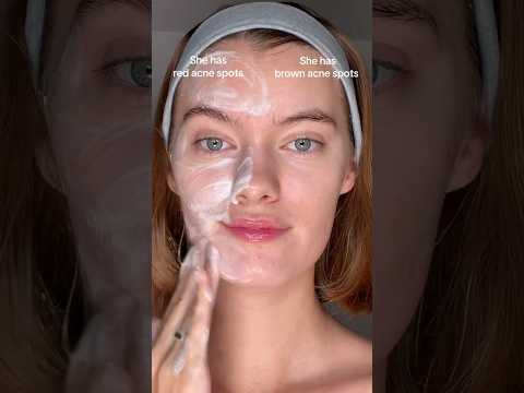 Because using the correct products really makes a difference 🤍✨#acne #acnepositivity #acnetreatment