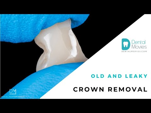 Old and leaky crown removal