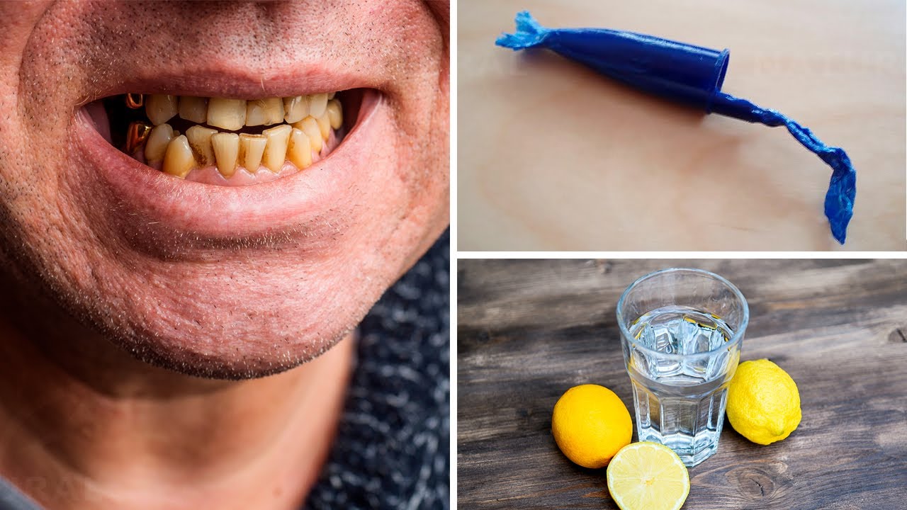 5 Bad Habits that can damage your Smile