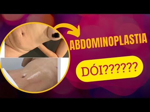 abdominoplastia dói? lipo dói? será isso mesmo?