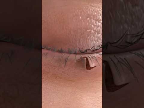 Ectropion Repair with Z-Plasty💫 Animation by @plastic.touch Unauthorized use or reposting of this…