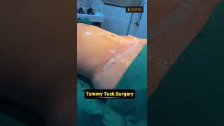Tummy Tuck Result