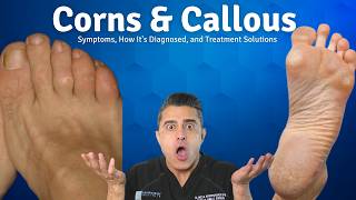 Corns or Calluses? Differences, Symptoms, and Effective Treatment Options