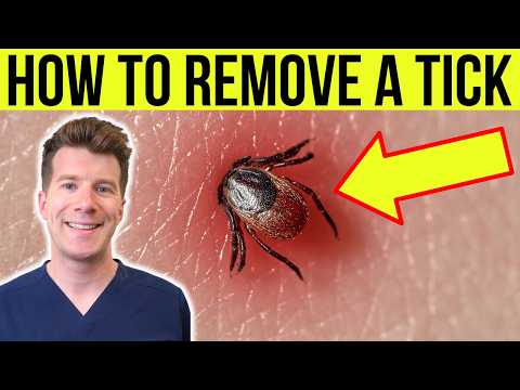 Doctor explains HOW TO REMOVE A TICK | Step-by-step guide