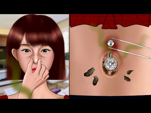 ASMR Satisfying navel stone removal animation‼️ Removing Pus from Piercing, Piercing Cleaning