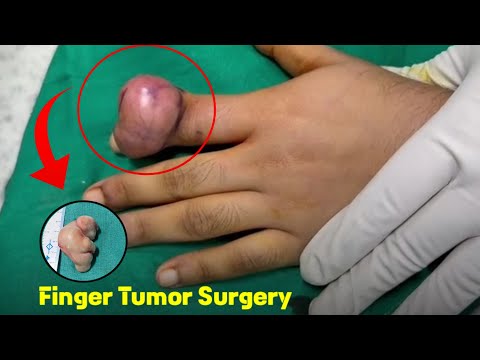 Finger Tumor Surgery || Dr Jayanta Bain plastic & cosmetic surgeon in Kolkata