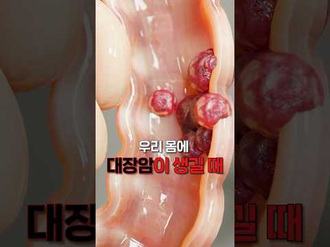 우리 몸에 대장암이 생길때 나타나는 위험신호 #대장암#위험신호