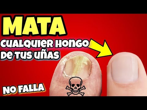 ESTO es 100 veces + EFECTIVO que otros remedios caseros para acabar con los Hongos en las Uñas