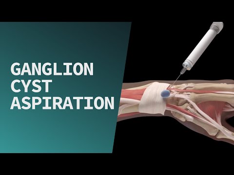 aspiration ganglion cyst