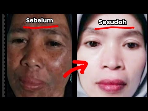 DIAMKAN SEKEJAP!!  CUCI DENGAN AIR!! WAJAH HITAM GOSONG JADI PUTIH SPERTI SUNTIK PUTIH!!