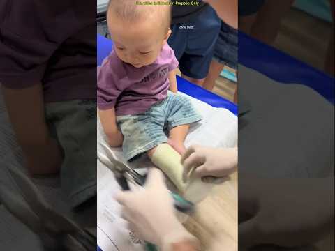 doctor finally freed the baby's leg after a month #shortvideo