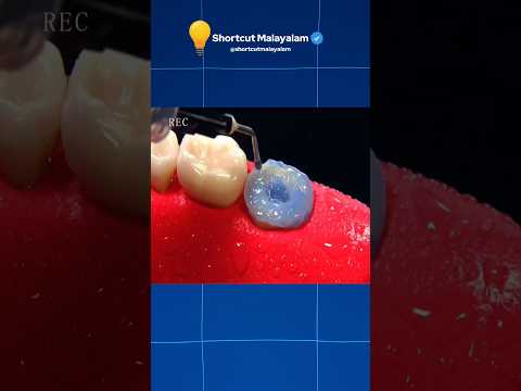 റൂട്ട് കനാൽ ചികിത്സ പൂർണ്ണ പ്രക്രിയ | Root Canal Treatment Explained in Malayalam 🦷✨