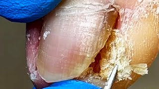 Wow~ Pedicure For A Lady, There Is Such A Big Ingrown Nail【Xue Yidao】
