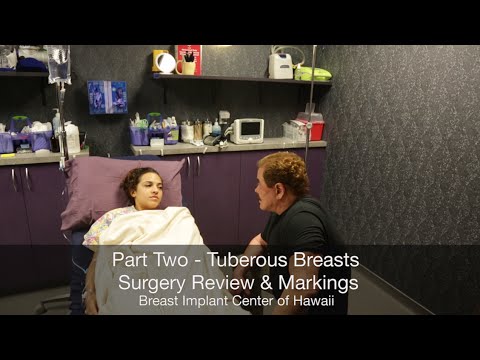 Tuberous Breasts Video Journey, Part Two, Surgery Prep - Dr. Larry Schlesinger - Breast Implant Center of Hawaii