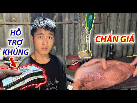 Chàng trai 18 tuổi tai nạn cụt mất chân sống lại hy vọng khi có khoản hỗ trợ khủng này.