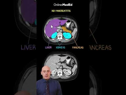 Clinical Reasoning: Managing Pancreatic Fluid Collections Post-Pancreatitis