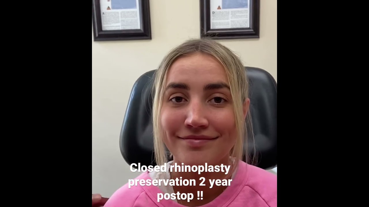 Patient two years post closed rhinoplasty procedure.