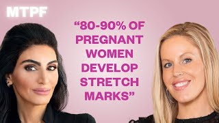 Stretch Marks: Causes, Prevention & Treatment Tips | More Than A Pretty Face Podcast