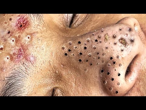 Blackhead Removal With Sac Dep Spa @100074205